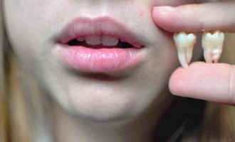 Os cuidados para quem extraiu o dente do siso