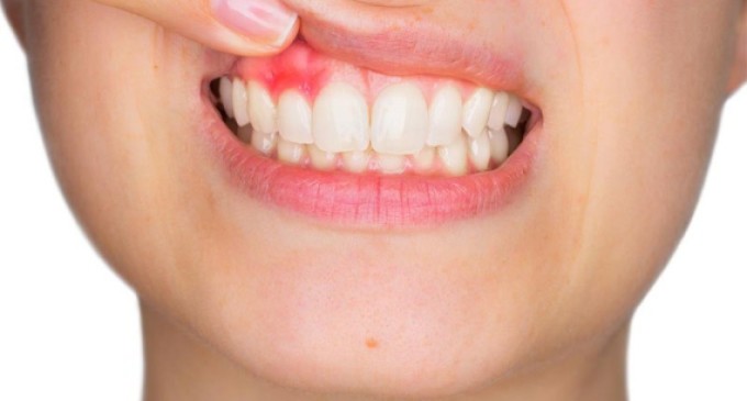 Estresse pode levar à perda dos dentes