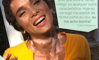 Campanha mostra que vitiligo não é contagioso