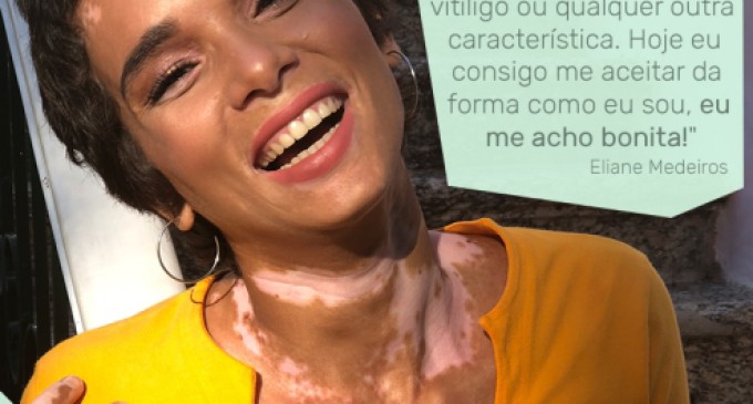 Campanha mostra que vitiligo não é contagioso