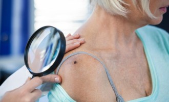 Ação constata 22% de casos suspeitos de câncer de pele em mais de mil pacientes avaliados