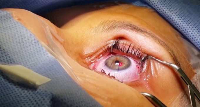 Cirurgia refrativa é mais segura que lente