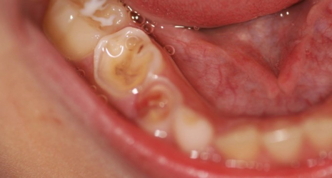Estudo revela que prevalência da erosão dentária em crianças é alta no Brasil