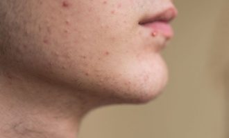 Dermatologista dá dicas para reduzir a incidência de acne; as populares espinhas