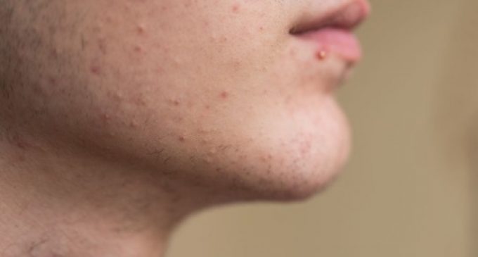 Dermatologista dá dicas para reduzir a incidência de acne; as populares espinhas